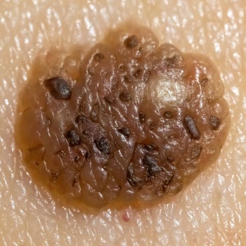 Anzeichen eines malignen Hautkrebses (Foto: IMAGO, xZoonar.com/MarvinxSamuelx)