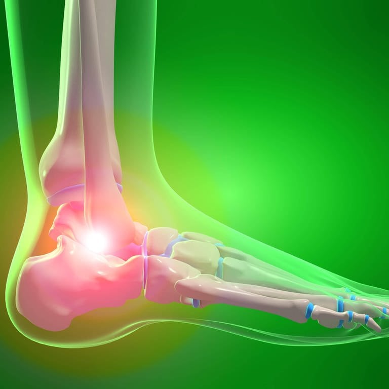 Arthrose im Fuß: Unter Arthrose versteht man eine primär verschleißbedingte Gelenkerkrankung, die prinzipiell alle Gelenke betreffen kann und verschiedene Ursachen hat