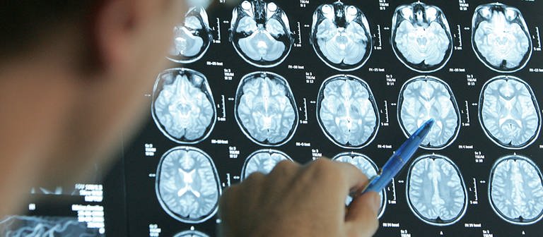 Ein Arzt deutet mit einem Stift auf die MRT-Bilder, die von einem Gehirn aufgenommen wurden. (Foto: picture-alliance / Reportdienste, picture-alliance/ dpa | Friso Gentsch)