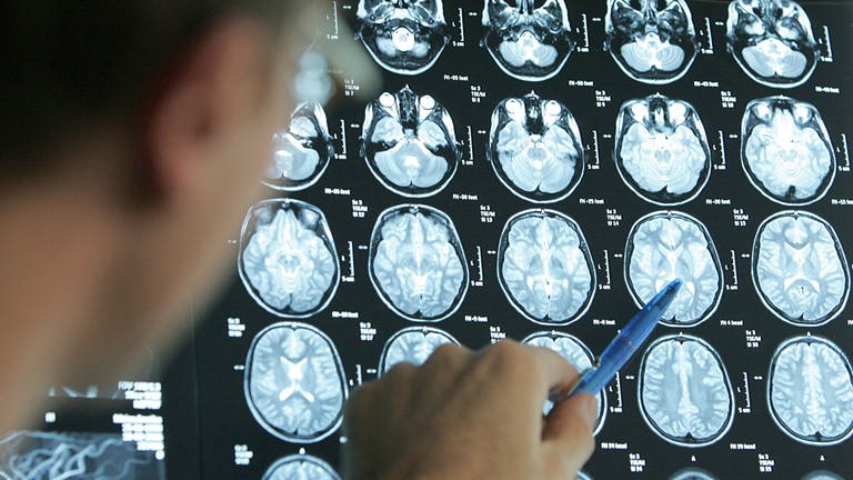 Ein Arzt deutet mit einem Stift auf die MRT-Bilder, die von einem Gehirn aufgenommen wurden.