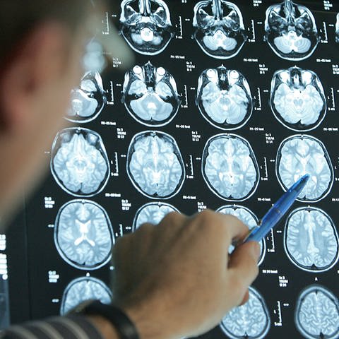 Ein Arzt deutet mit einem Stift auf die MRT-Bilder, die von einem Gehirn aufgenommen wurden. (Foto: picture-alliance / Reportdienste, picture-alliance/ dpa | Friso Gentsch)