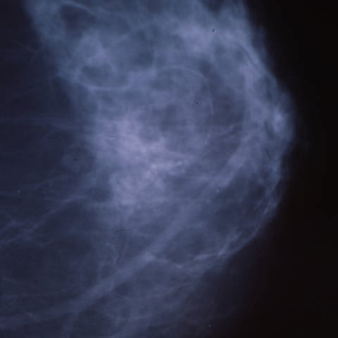 Mammografie einer weiblichen Brust (Foto: IMAGO, IMAGO / YAY Images)