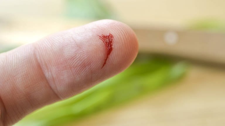Blutender Zeigefinger: Eine Schnittwunde am Finger genügen, schon gelangen Keime in den Körper. Was harmlos beginnt, kann sich binnen Stunden zu einer tödlichen Blutvergiftung entwickeln. (Foto: IMAGO, imago images / Niehoff)