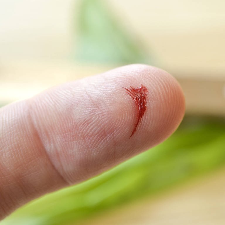 Blutender Zeigefinger: Eine Schnittwunde am Finger genügen, schon gelangen Keime in den Körper. Was harmlos beginnt, kann sich binnen Stunden zu einer tödlichen Blutvergiftung entwickeln. (Foto: IMAGO, imago images / Niehoff)
