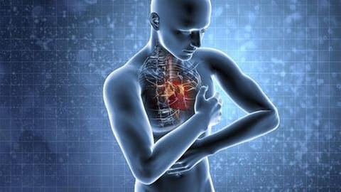 Computeranimation eines Herzinfarktes. (Foto: Getty Images, Thinkstock -)