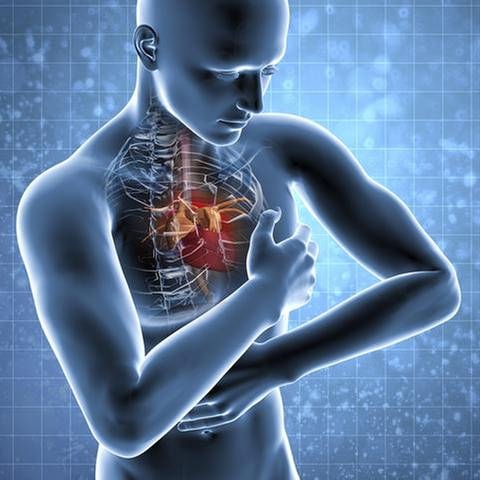 Computeranimation eines Herzinfarktes. (Foto: Getty Images, Thinkstock -)