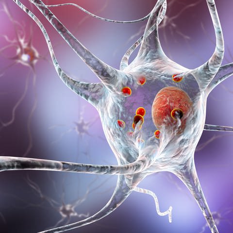 Ablagerungen von Proteinen sammeln sich bei Parkinson in den Gehirnzellen an und verursachen deren fortschreitende Degeneration. (Foto: IMAGO, IMAGO / agefotostock)