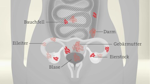Endometriose ist eine Krankheit, die von der Gebärmutter ausgeht. Zellen der Gebärmutterschleimhaut siedeln sich außen an: zum Beispiel am Darm, am Eierstock, an den Eileitern, an der Blase oder auch am Bauchfell. (Foto: SWR)