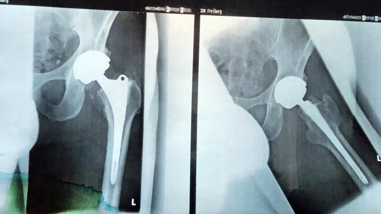 Eingesetzte Hüftprothese von Zimmer Biomet auf einem Röntgenbild (Foto: SWR, Elisa Rijntjes-Hassouraki)