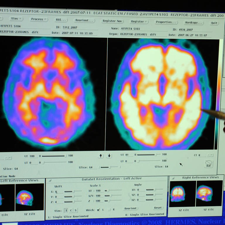 Gehirn von einem gesunden und einem Alzheimer-Patienten