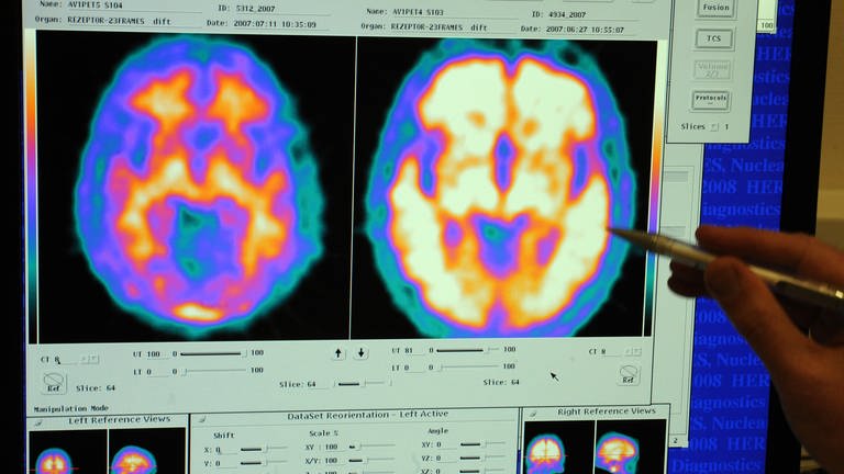Gehirn von einem gesunden und einem Alzheimer-Patienten (Foto: dpa Bildfunk, Picture Alliance)