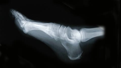 Die Erkenntnisse der Ulmer Wissenschaftler könnten für die Behandlung von gestressten Patienten mit Knochenbrüchen interessant sein. Ohne Stress scheinen Knochen schneller zusammenzuwachsen. (Foto: IMAGO, IMAGO / INSADCO)