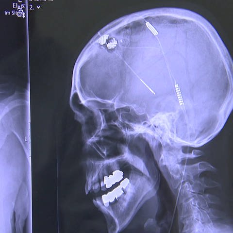 ein bildgebendes Verfahren zeigt die Position eines Hirnschrittmachers im Gehirn eines Patienten an (Foto: SWR)