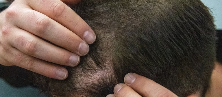 Symbolbild: Ein Mann aus Trier ist bei einer illegalen Haartransplantation vor Schmerzen bewusstlos geworden (Foto: dpa Bildfunk, picture alliance/dpa | Lino Mirgeler (Symbolbild))