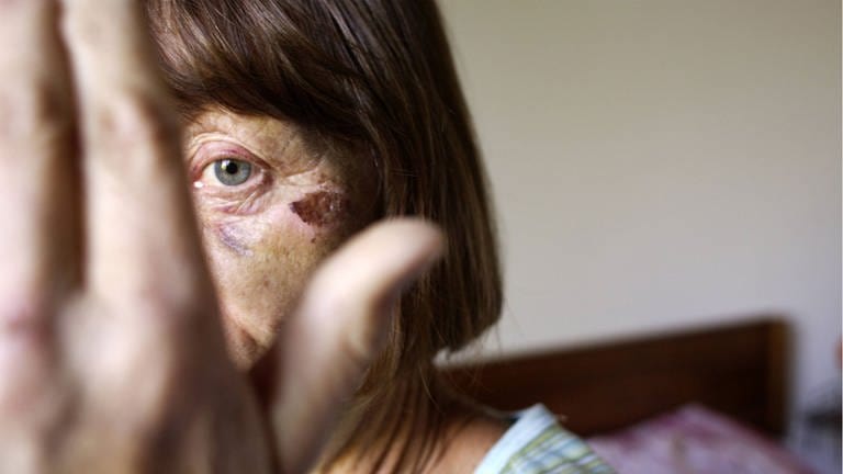 Geschlagene Frau mit einem verletzten Auge