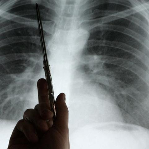 Lungenkrebsdiagnose (Foto: Colourbox, Foto: Colourbox.de -)
