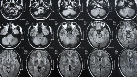 Kernspintomographie-Aufnahme von menschlichem Kopf (Foto: SWR, picture-alliance / dpa -)