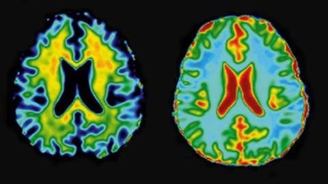Gehirn mit Magnetresonanztomografie