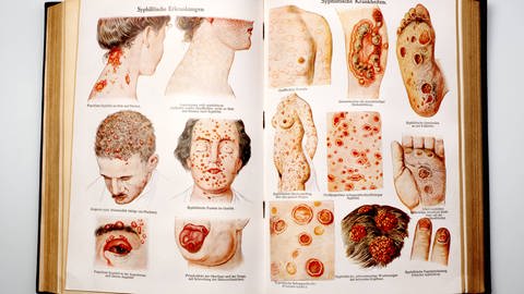 Abbildung aus dem Buch: "Syphilitische Krankheiten" von "Dr. F. König. (Foto: IMAGO, Copyright: imago/imagebroker)