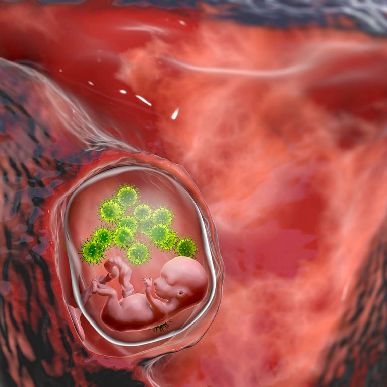 Embryo wird im Mutterleib mit Viren infiziert (Grafik): Bei einer Infektion mit dem Zytomegalie-Virus in der Schwangerschaft kann das Kind schwerwiegende Schäden davontragen.  (Foto: IMAGO, IMAGO / Science Photo Library)