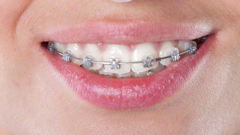 Zahnspangen – medizinisch sinnvoll oder oft nur reiner Luxus? (Foto: IMAGO, imago images / YAY Images)