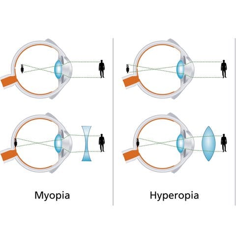 Schematische Darstellung von Myopie und Hyperopie