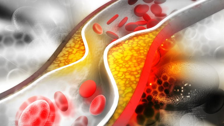 Cholesterin-Plaque in der Arterie (grafische Darstellung) (Foto: IMAGO, IMAGO / agefotostock)