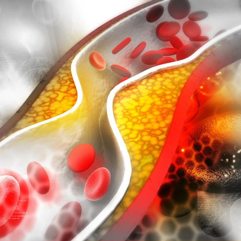 Cholesterin-Plaque in der Arterie (grafische Darstellung) (Foto: IMAGO, IMAGO / agefotostock)