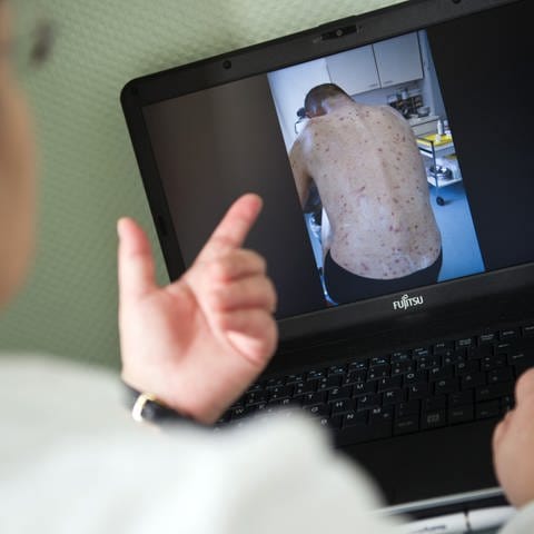 Foto auf ihrem Laptop von einem Patienten der von Krätze befallen (Foto: picture-alliance / Reportdienste, picture alliance / dpa | Daniel Naupold)