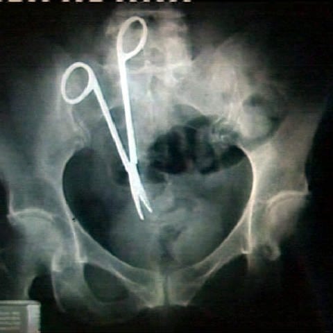 Eine Röntgenaufnahme zeigt eine chirurgische Schere, die in den Bauch einer Frau eingebettet ist.