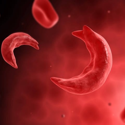 Mikroskopische Ansicht kranker Zellen, die Anämie verursachen. (Foto: IMAGO, IMAGO / StockTrek Images)