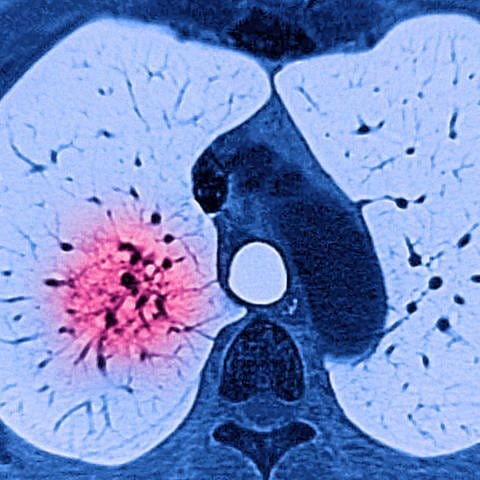 CT-Scan der Lunge 