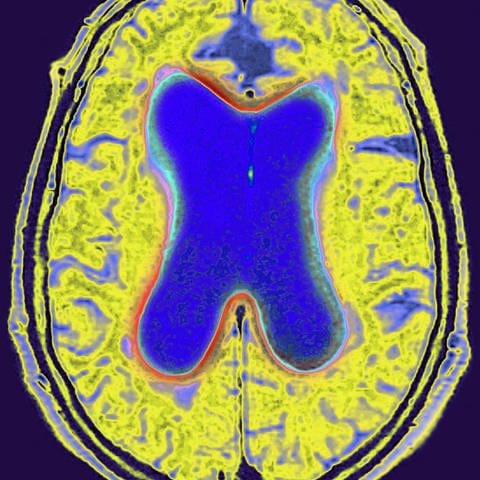 Radiales MRT des Gehirns. (Erweiterung aufgrund altersbedingter Hirnatrophie, Alzheimer-Krankheit).  (Foto: picture-alliance / Reportdienste, picture alliance / BSIP | CAVALLINI JAMES)