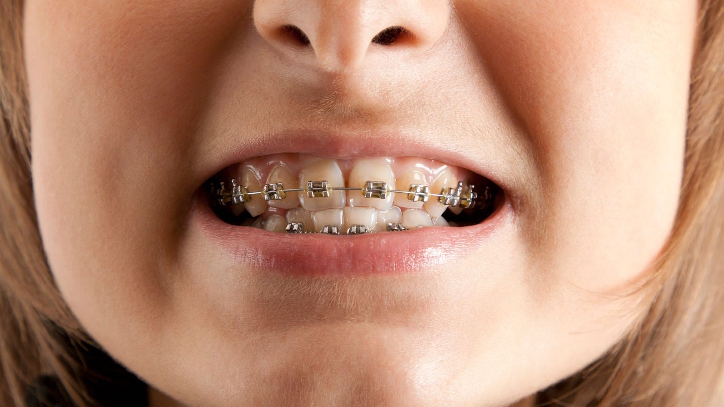 Ein Mädchen lächelt mit Klammer auf den Zähnen. (Foto: IMAGO, IMAGO / Zoonar)