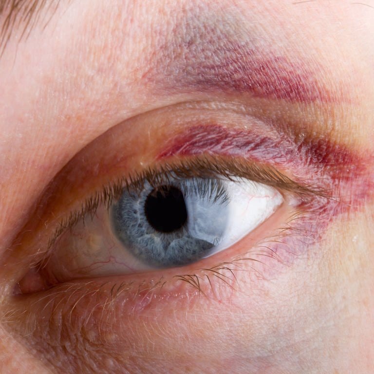 Auge mit Veilchen, also einem Hämatom (Foto: IMAGO, imago images/YAY Images)