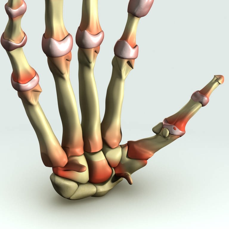 Knochen und Gelenke einer Hand mit rheumatischer Arthritis (Grafik): Die rheumatoide Arthritis ist die häufigste entzündliche Gelenkerkrankung