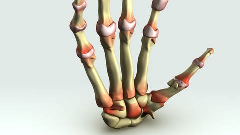 Knochen und Gelenke einer Hand mit rheumatischer Arthritis (Grafik): Die rheumatoide Arthritis ist die häufigste entzündliche Gelenkerkrankung (Foto: IMAGO, IMAGO / agefotostock)