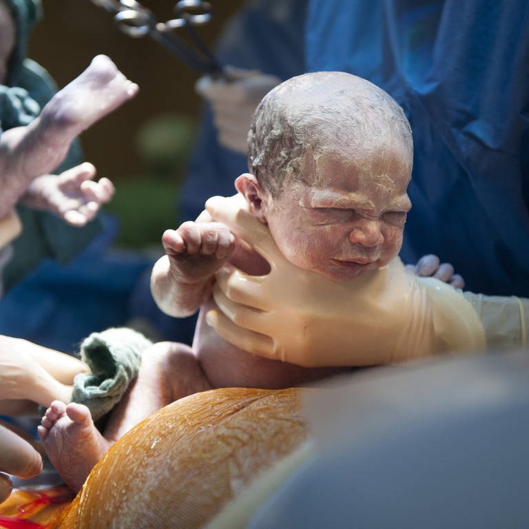 Eine Frau entbindet Zwillinge per Kaiserschnitt mithilfe eines OP-Teams: Wenn keine Risiken vorliegen und es keinen medizinischen Grund gibt, sollte die Frau normal entbinden und keinen Kaiserschnitt erhalten. (Foto: IMAGO, IMAGO / Reporters)