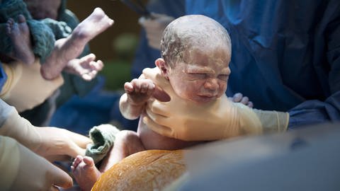 Eine Frau entbindet Zwillinge per Kaiserschnitt mithilfe eines OP-Teams: Wenn keine Risiken vorliegen und es keinen medizinischen Grund gibt, sollte die Frau normal entbinden und keinen Kaiserschnitt erhalten. (Foto: IMAGO, IMAGO / Reporters)