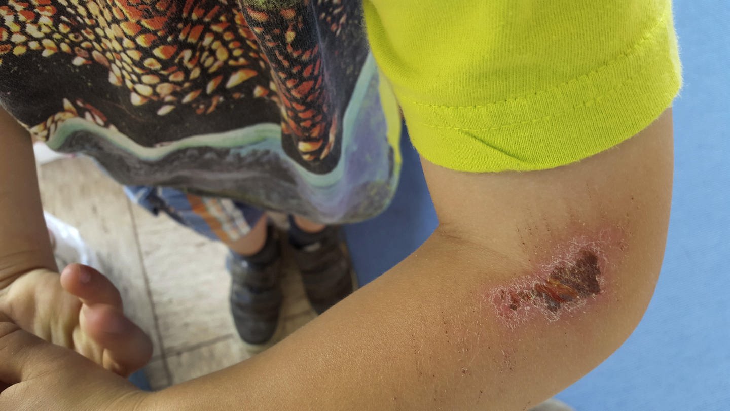 Schürfwunde am Arm eines Kindes: Wenn Wunden heilen, juckt die Haut. Menschliche Zellen kommunizieren miteinander, und das Jucken ist das 