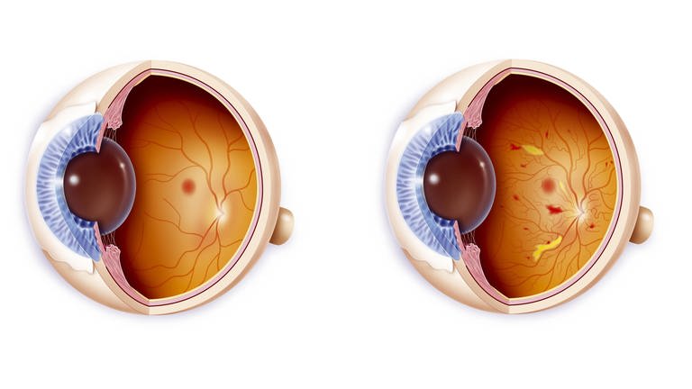 Illustration eines gesunden Auges (links) und eines von diabetischer Retinopathie betroffenen Auges