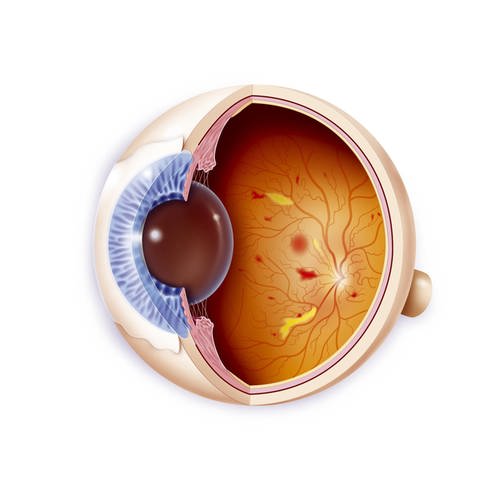 Illustration eines gesunden Auges (links) und eines von diabetischer Retinopathie betroffenen Auges