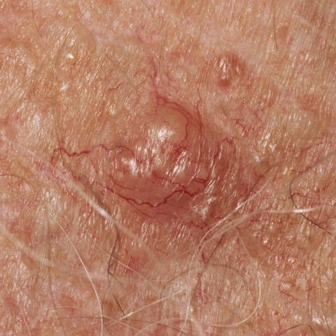 Basalzellkarzinom: Ein Basaliom ist ein Hautkrebs, der vor allem an solchen Stellen der Haut auftritt, die immer wieder der Sonne ausgesetzt sind, also zum Beispiel im Gesicht. (Foto: IMAGO, IMAGO / Science Photo Library)