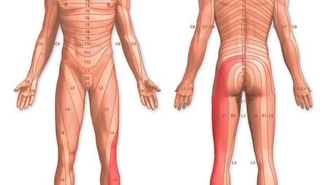 Aufteilung der Haut in Dermatome entsprechend der Rückenmarks-Abschnitte