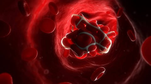 Derzeit wird erforscht, ob Blutverdünnner bei schweren Verläufen einer Covid-19 Erkrankung das Risiko von Thrombosen oder Lungenembolien verringern können. (Foto: IMAGO, imago)