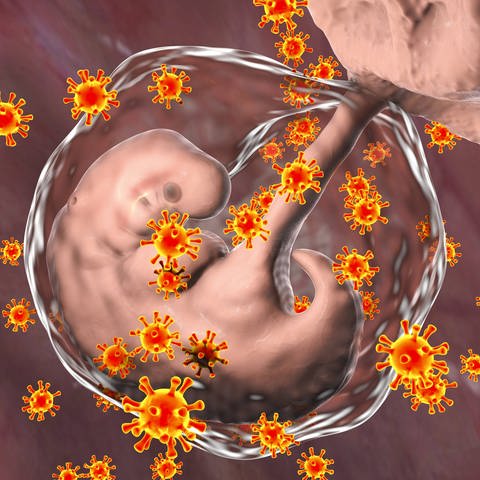Auch andere Viren können über die Plazenta das Ungeborene infizieren und teils schwere Komplikationen auslösen.  (Foto: IMAGO, imago/Science Photo Library)