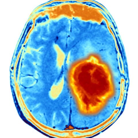MRT-Aufnahme eines Hirntumors (Foto: IMAGO, imago/Science Photo Library)