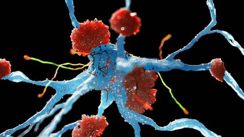 Von Alzheimer betroffene Nervenzellen (Foto: IMAGO, imago images/Science Photo Library)