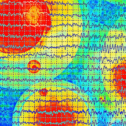 EEG eines Parkinson-Patienten (Foto: IMAGO, IMAGO / agefotostock)