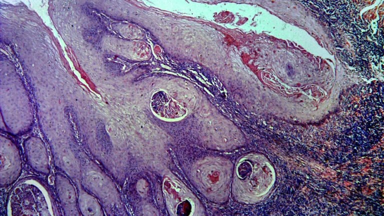 Histologischer Schnitt durch Gewebe von Hautkrebs (Foto: IMAGO, imago images/blickwinkel)